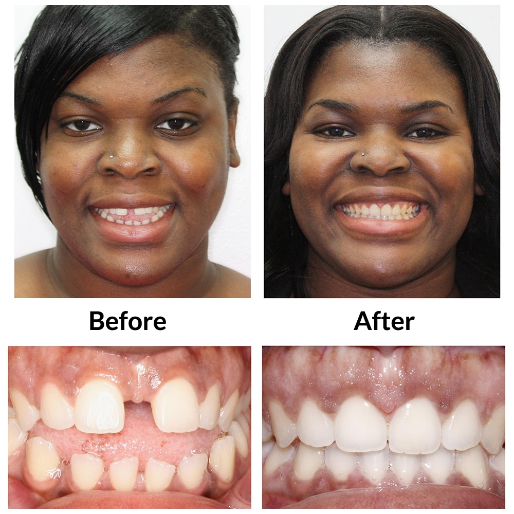 Adult 3 Invisalign Before and After