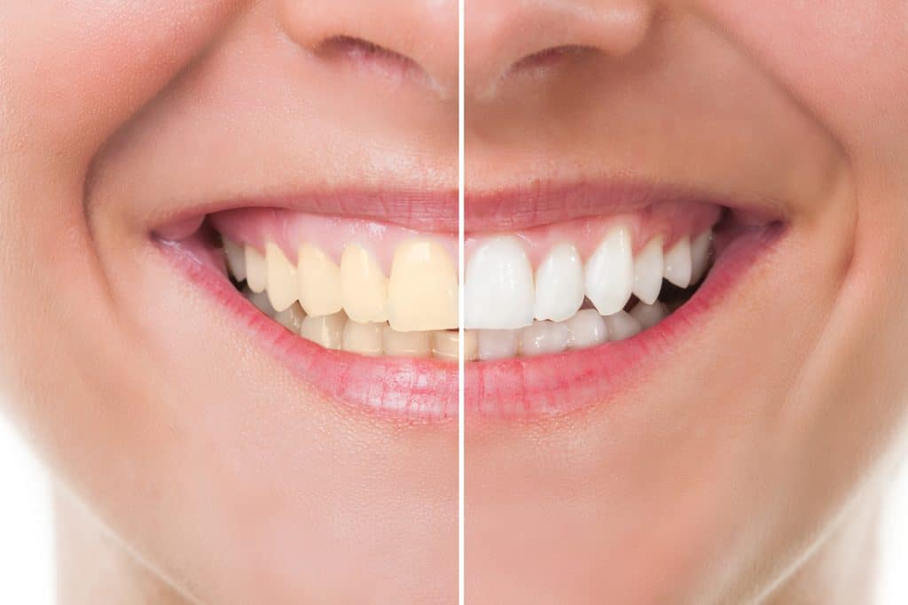 How Does Teeth Whitening Work in a Dental Office?