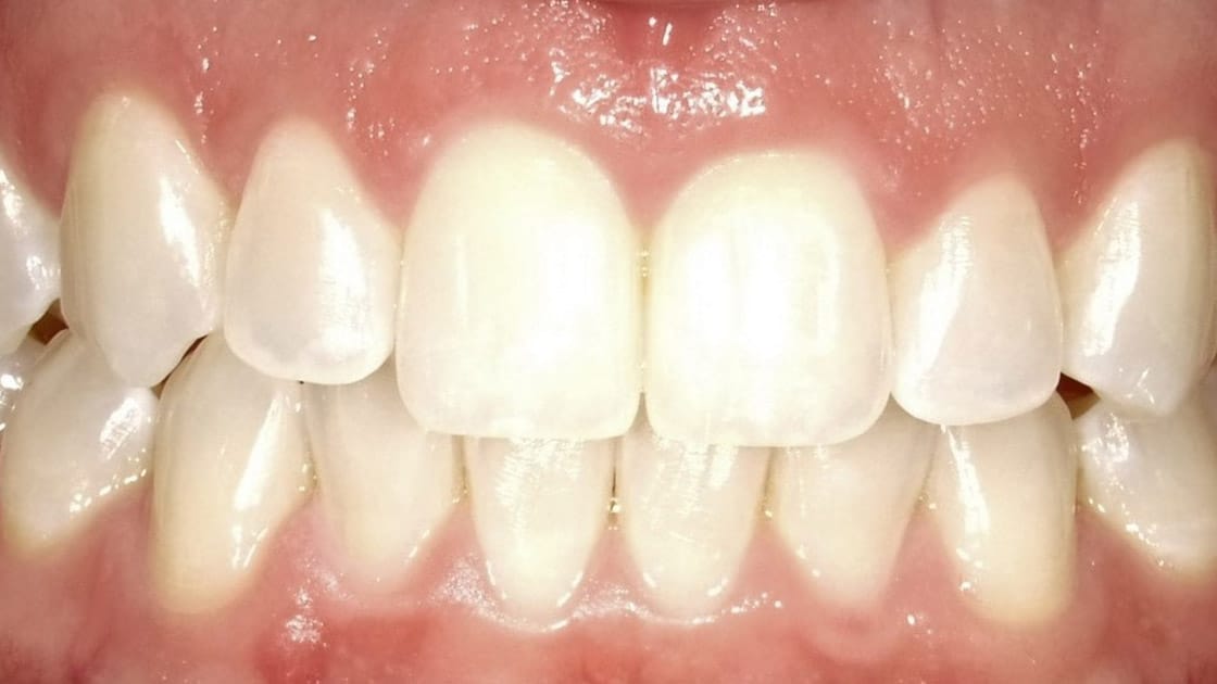 invisalign-after