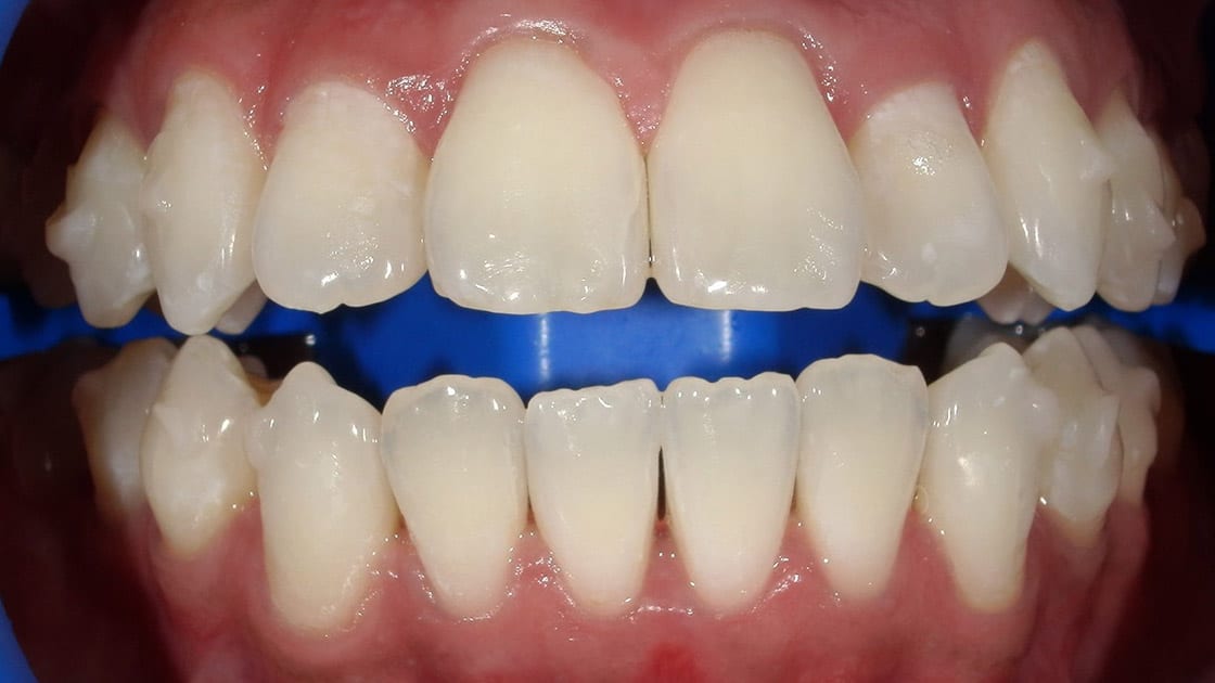 Whitening-After